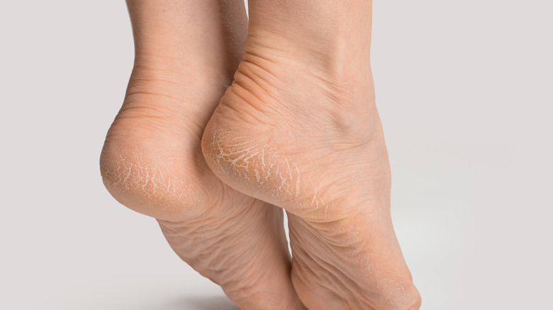 Feet with cracked heels on tiptoes