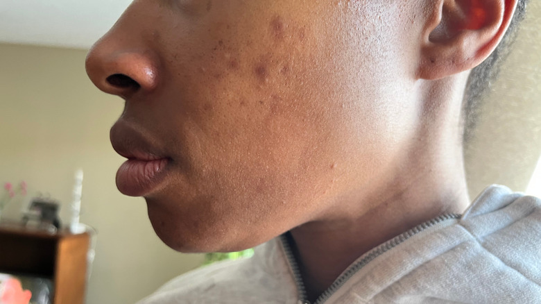 Person with acne scarring