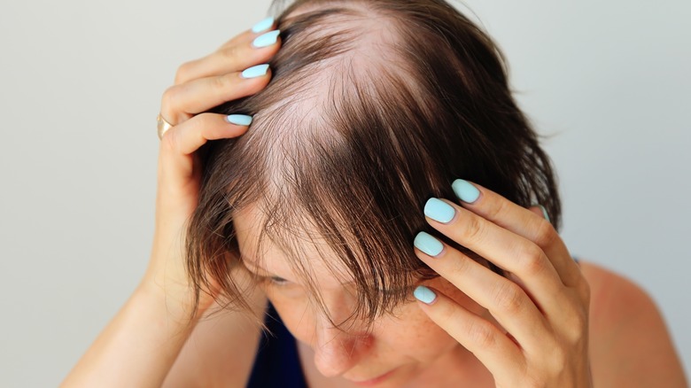 female with alopecia