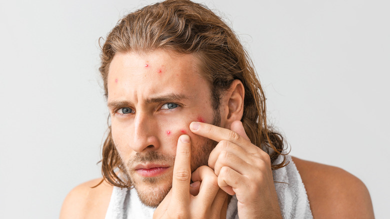 young man with acne on skin