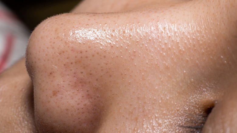 dark sebaceous filaments on nose