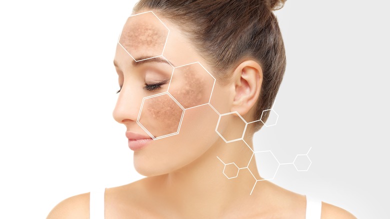 hyperpigmentation illustrated on model's face 
