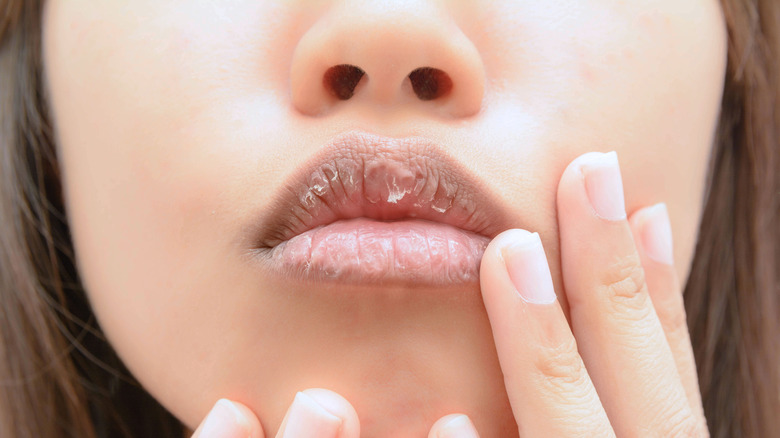 woman with dry, chapped lips
