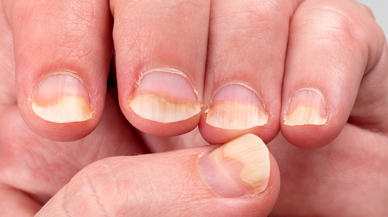 girl with nail psoriasis