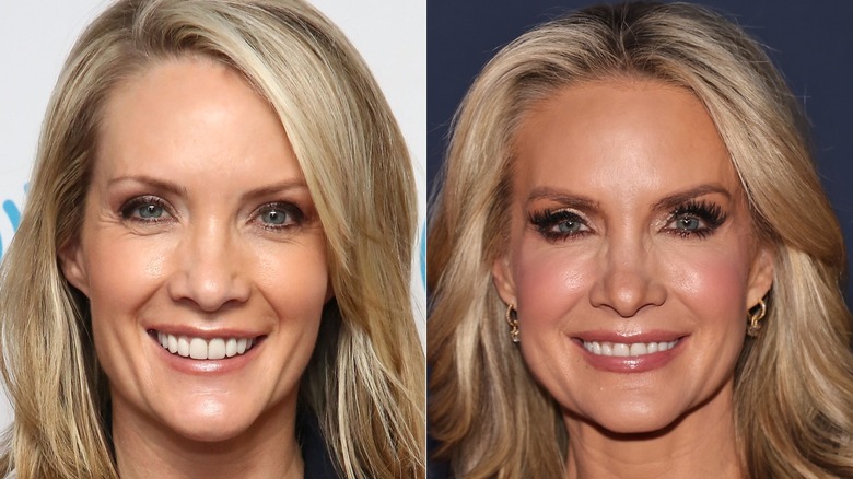 Dana Perino posing for a photo in 2016, before plastic surgery allegations, and ﻿Dana Perino in 2024 after plastic surgery allegations﻿