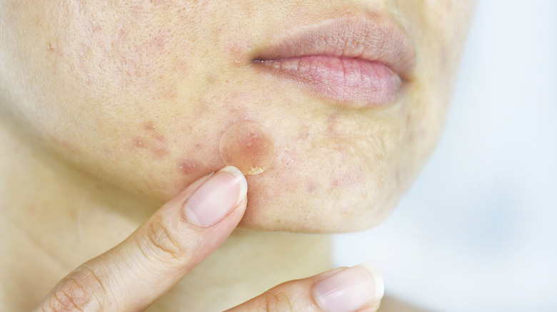 woman touching pimple patch