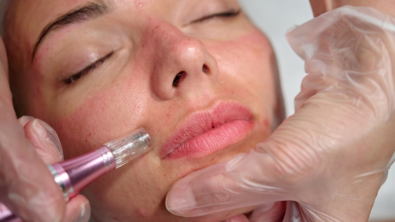 microneedling