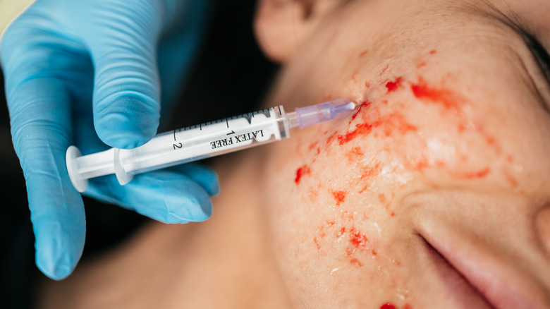 Needle injection in PRP treatment