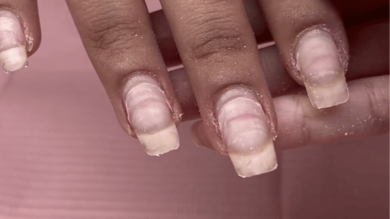 Close-up of ring of fire affliction on nails