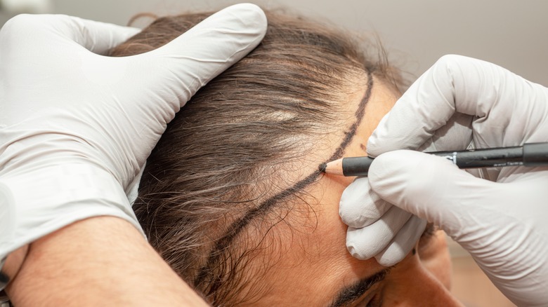 woman with receding hairline outline