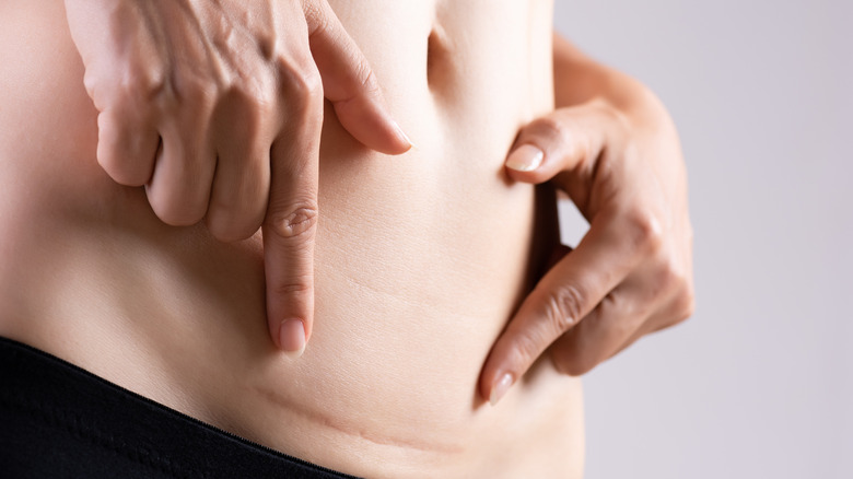 woman with c-section scar