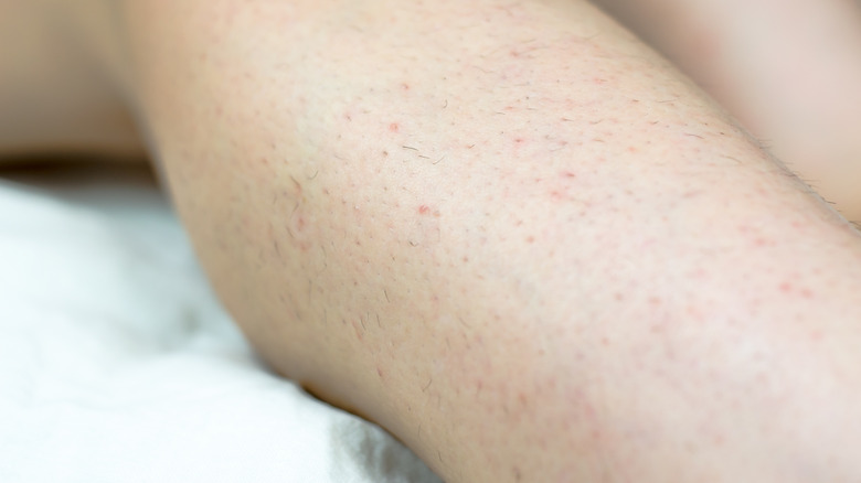 Closeup of hair regrowth on legs