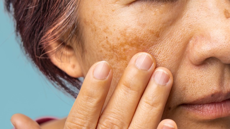 melasma on face