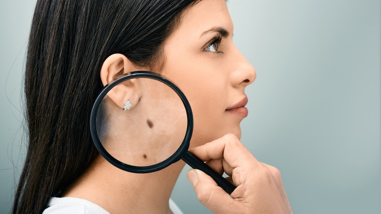 Examining moles with magnifying glass