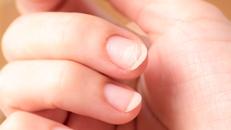 woman with a flaky nail 