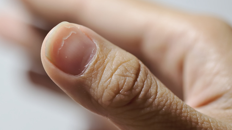 woman with flaky nail 