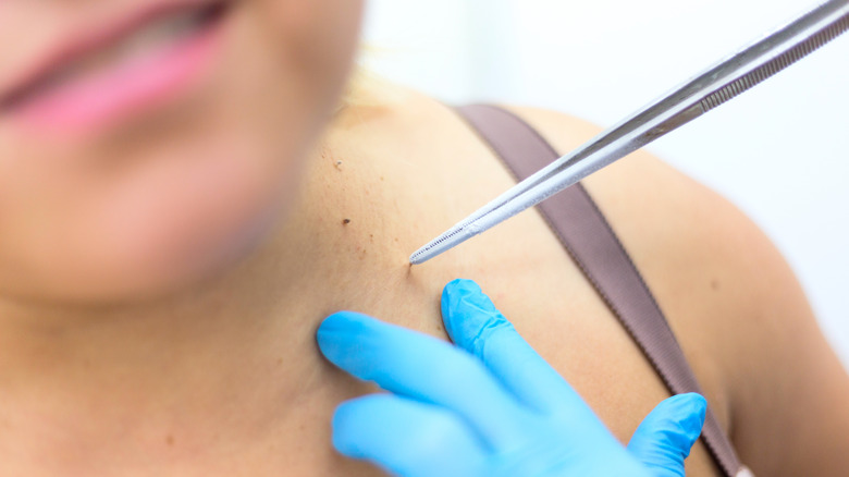 Cryosurgery being applied to skin tag