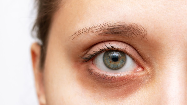 tired woman's eye dark circles