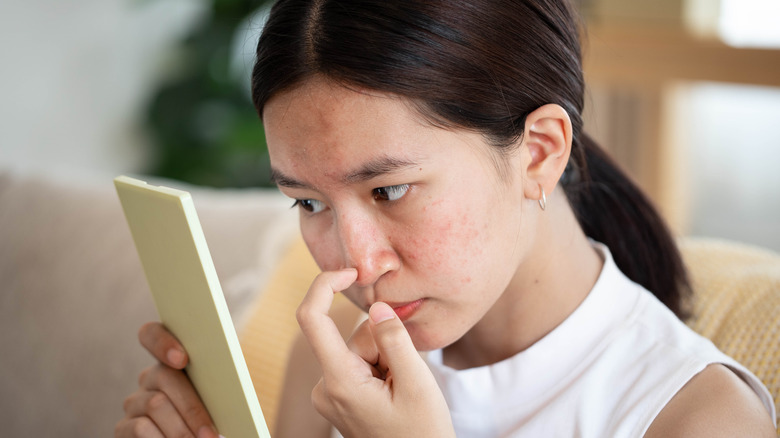 Woman suffering from acne