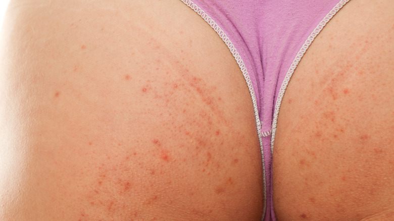 butt acne