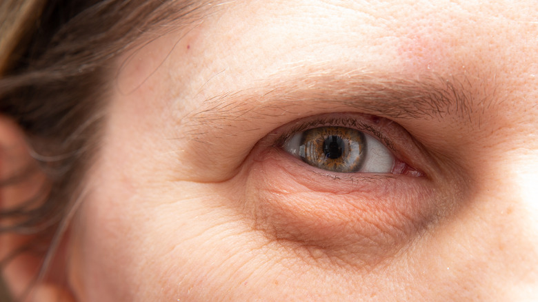 Close up of eye bags