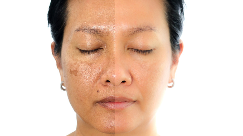 Model with facial sun damage