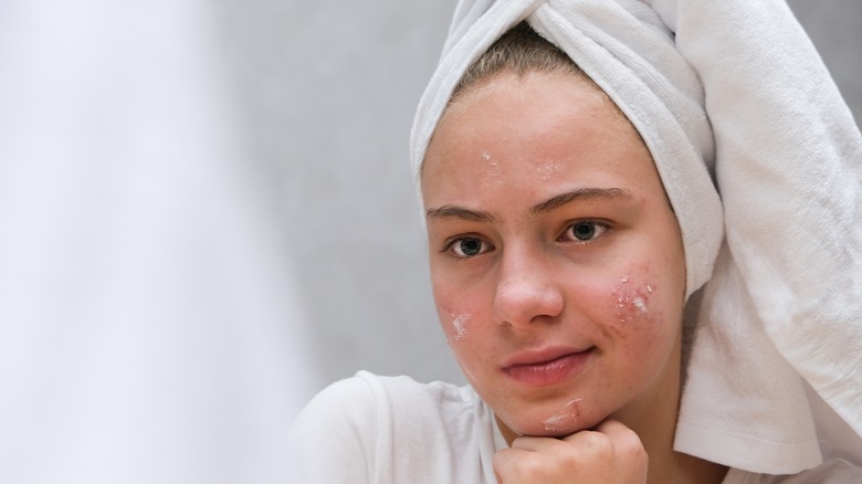 woman with acne looking in the mirror 