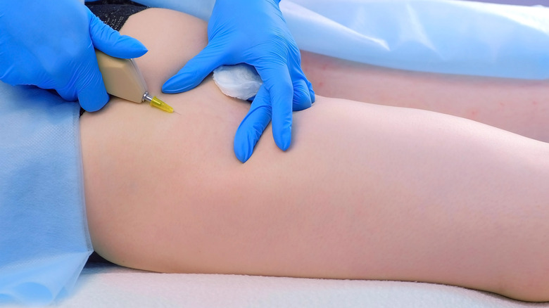 Carboxytherapy session