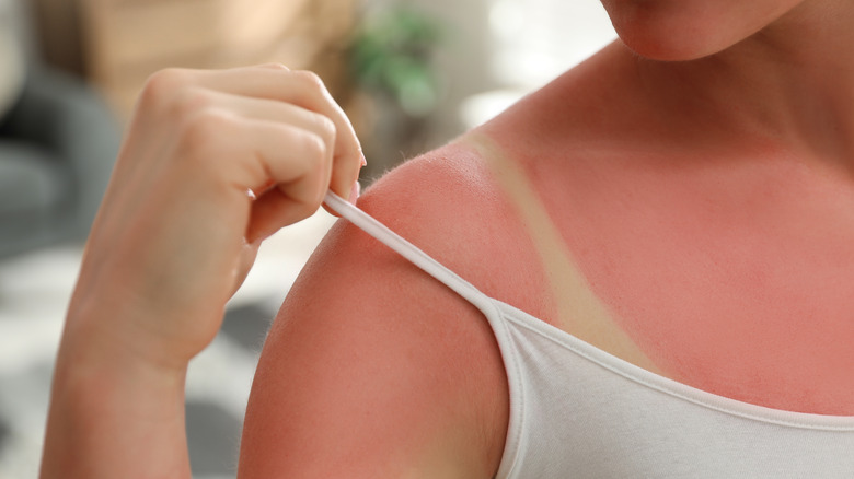 woman looking at sunburn 