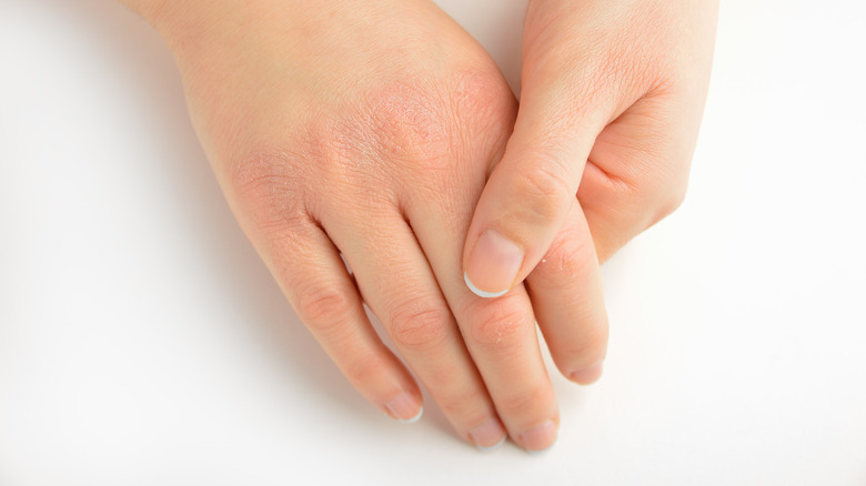 Pinching skin on knuckles 