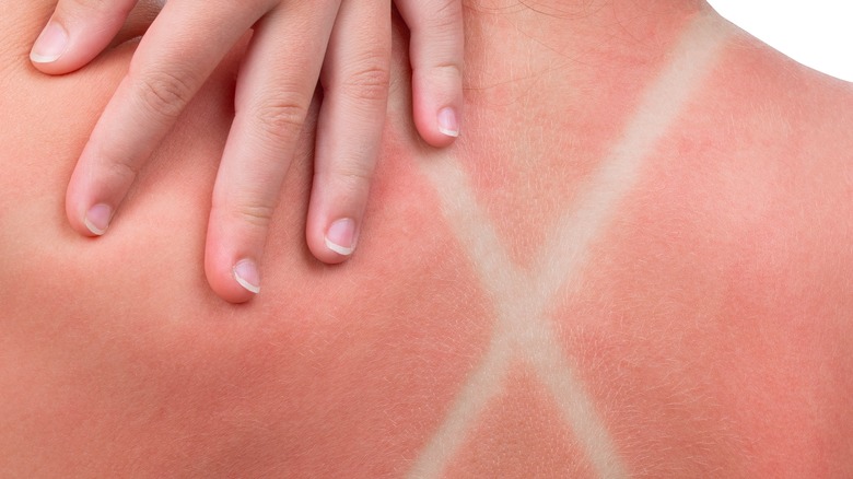 female sunburn marks