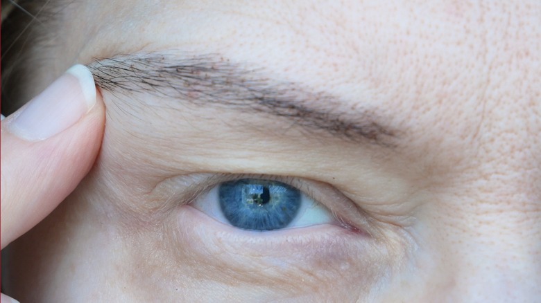 Drooping eyelid ptosis