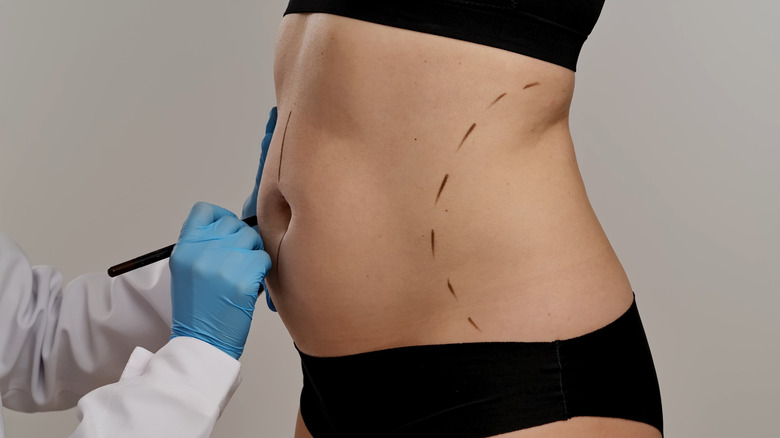 A patient being prepped for liposuction by having lines marked on their stomach