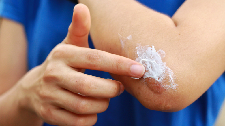 Woman applying a topical ointment to her elbow