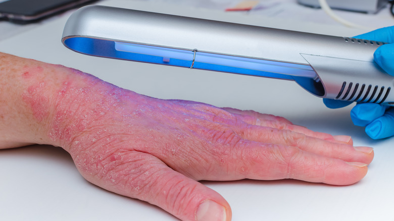 Phototherapy being applied to someone's hand
