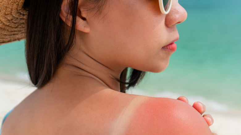 Woman with sunburned shoulders