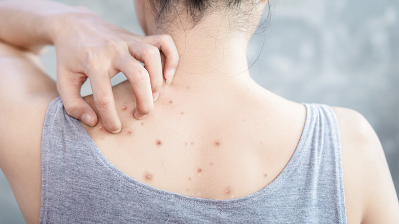 person with back acne