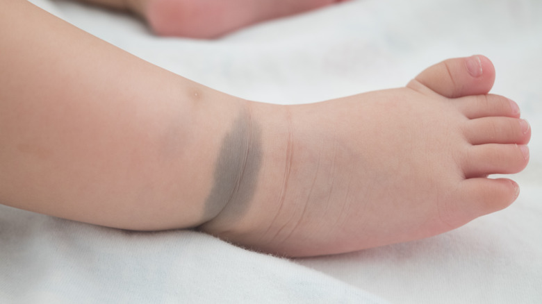 Birthmark on baby's leg