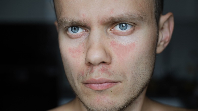 Man with butterfly rash on face