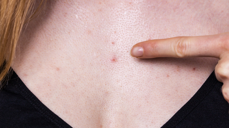 close up of chest acne