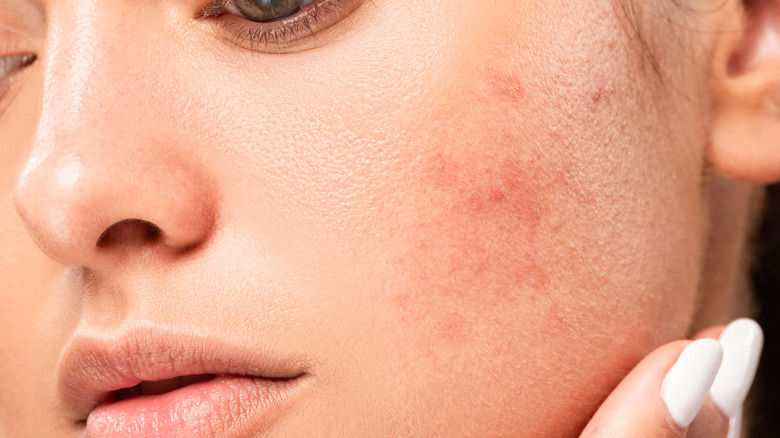 Woman touching acne breakout