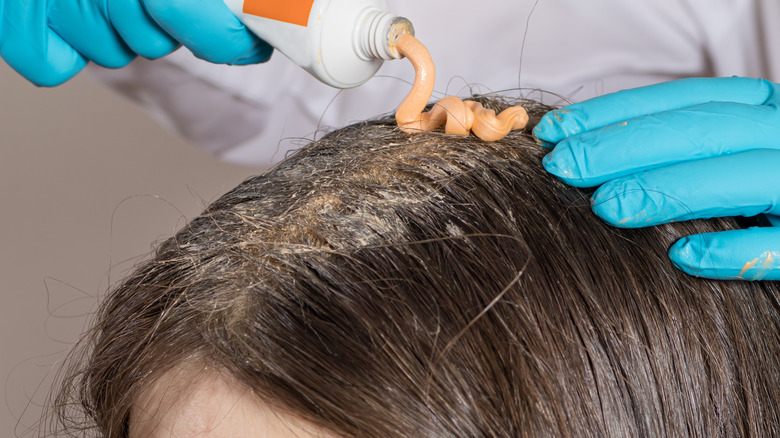 Dandruff treatment applied to scalp