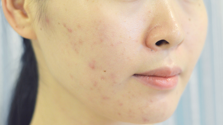 Woman with acne