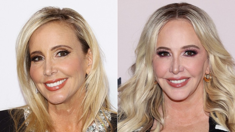 Shannon Beador smiling before and after her facelift