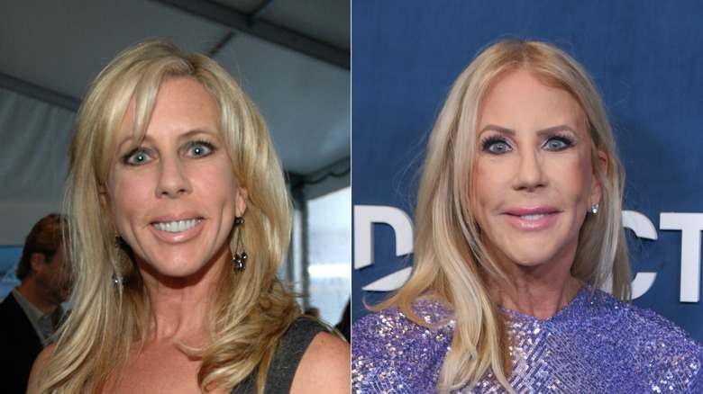 Vicki Gunvalson smiling before and after face tweaks