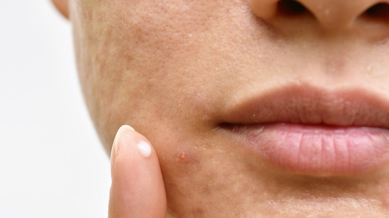 woman applying ointment to pimple
