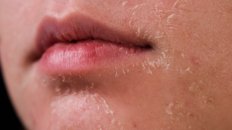 woman with flaky skin