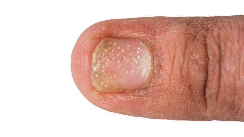 fingernail showing nail pitting