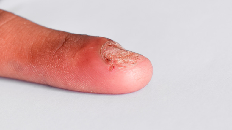 damaged finger swollen nail fold