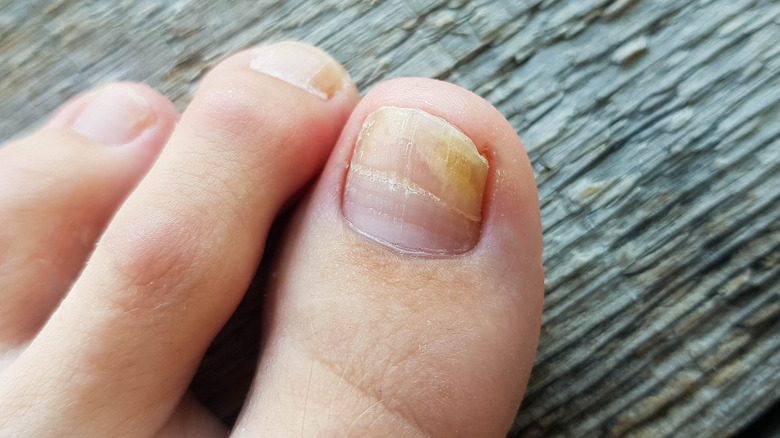 a separated big toenail